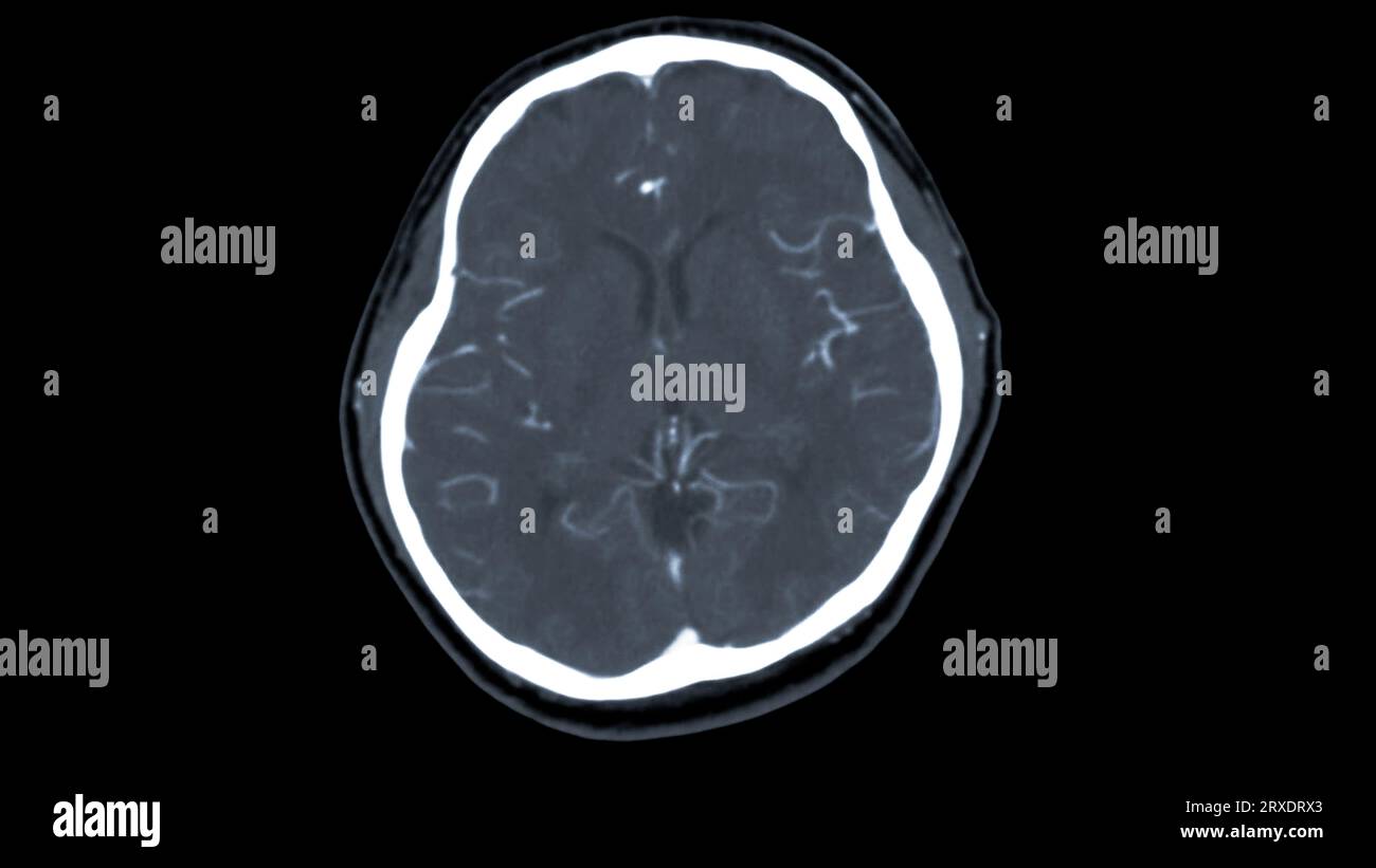 CT scan of the brain with injection contrast media  for diagnosis brain tumor,stroke diseases and vascular diseases. Stock Photo
