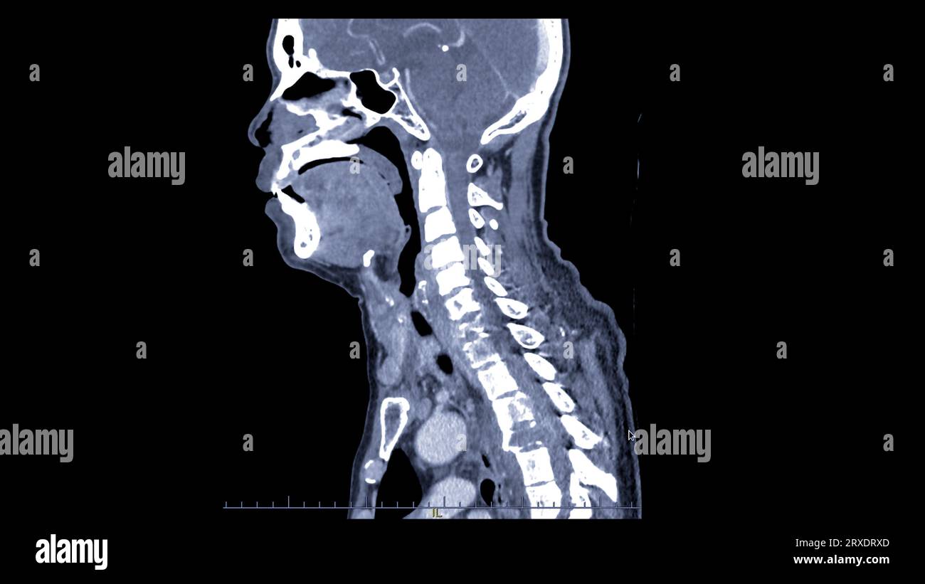 CT C-Spine or Cervical spine sagittal view. Stock Photo