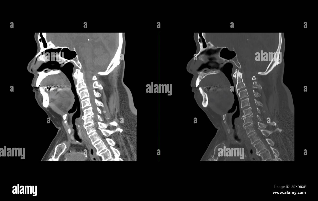 CT C-Spine or Cervical spine sagittal view. Stock Photo