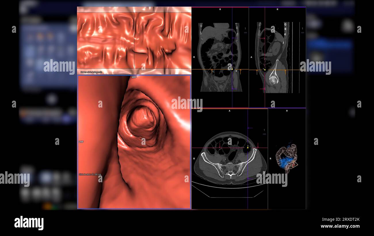 CT colonography compare 2D Axial,sagittal ,coronal plane and 3D rendering image for screening colorectal cancer. For annual health check-ups to screen Stock Photo