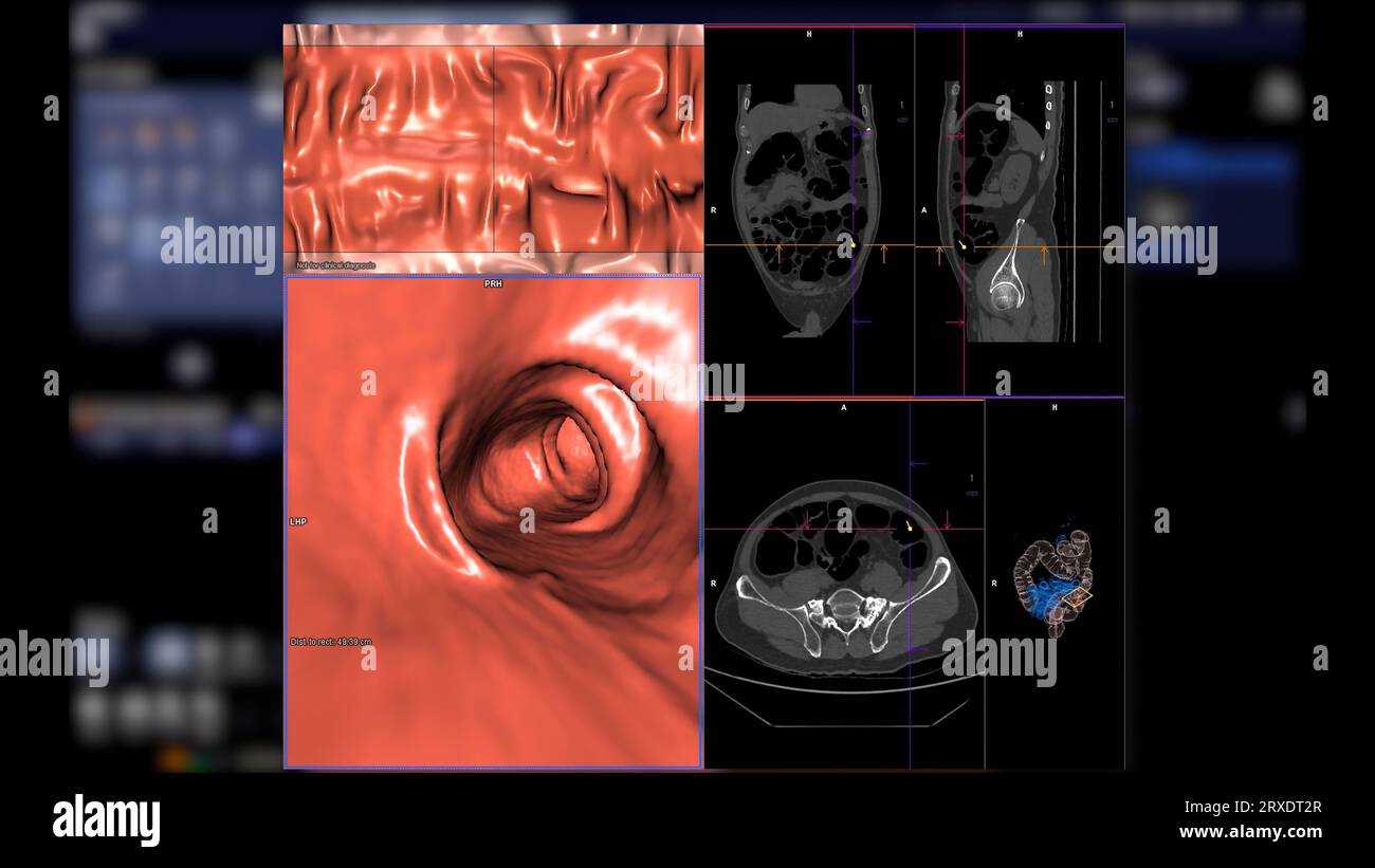 CT colonography compare 2D Axial,sagittal ,coronal plane and 3D rendering image for screening colorectal cancer. For annual health check-ups to screen Stock Photo