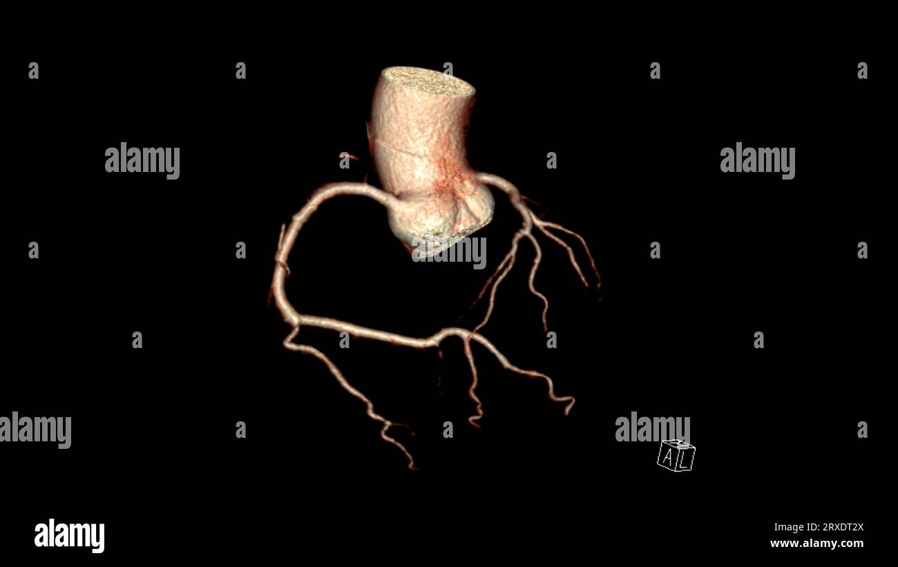 CT Cardiac 3D rendering  or CTA coronary artery for prevention coronary artery diseases. Stock Photo