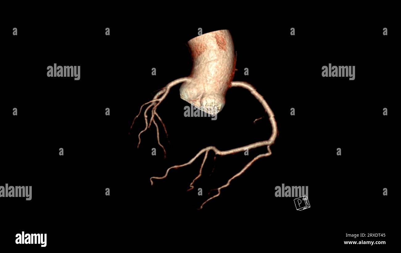 CT Cardiac 3D rendering or CTA coronary artery for prevention coronary ...