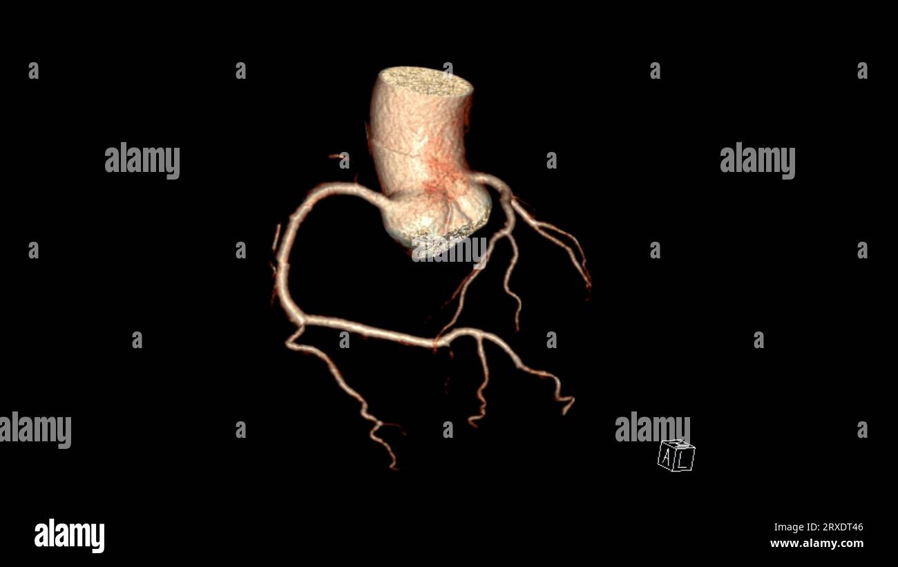 CT Cardiac 3D rendering or CTA coronary artery for prevention coronary ...