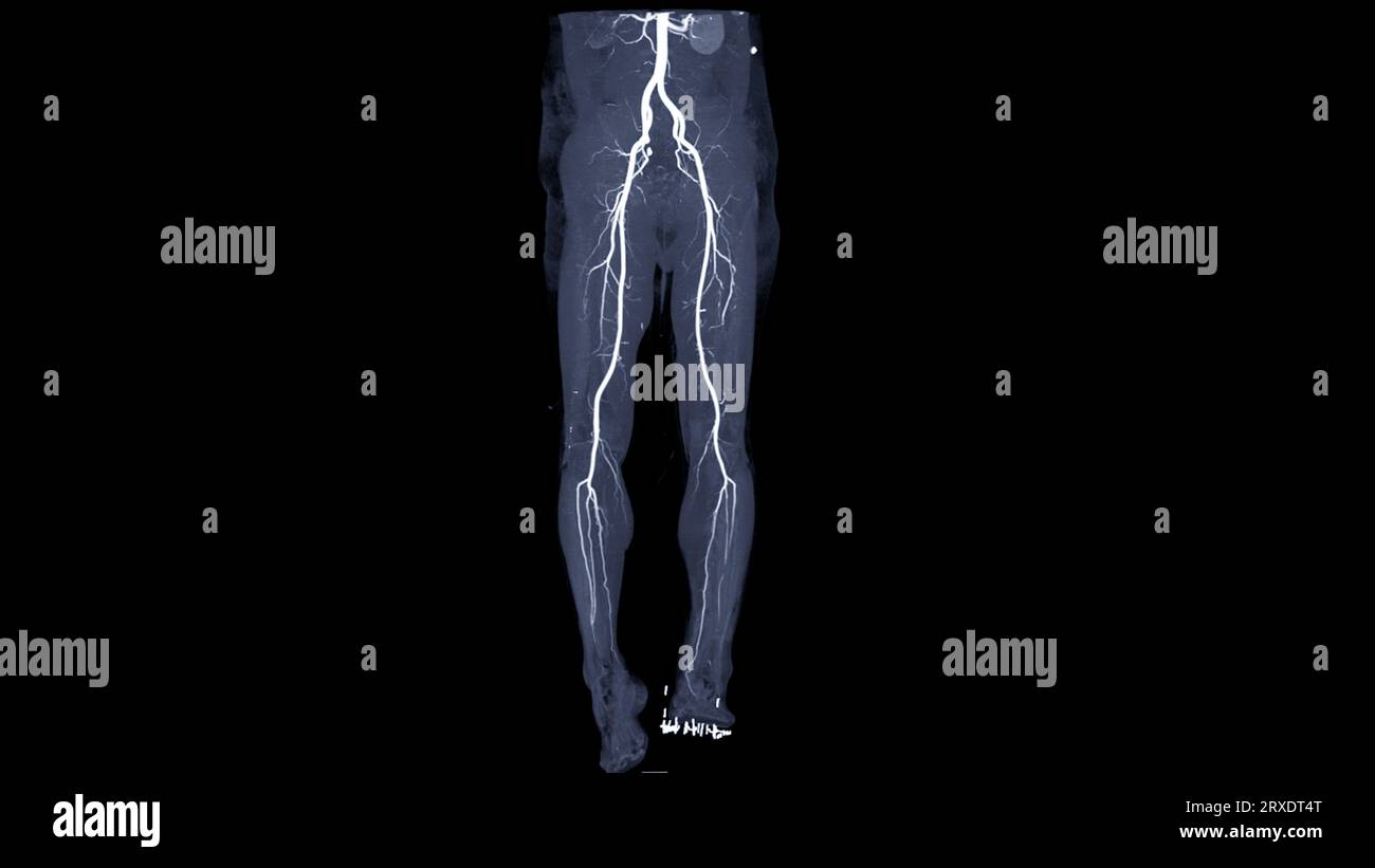 CTA femoral artery run off showing  femoral artery for diagnostic  Acute or Chronic Peripheral Arterial Disease. Stock Photo