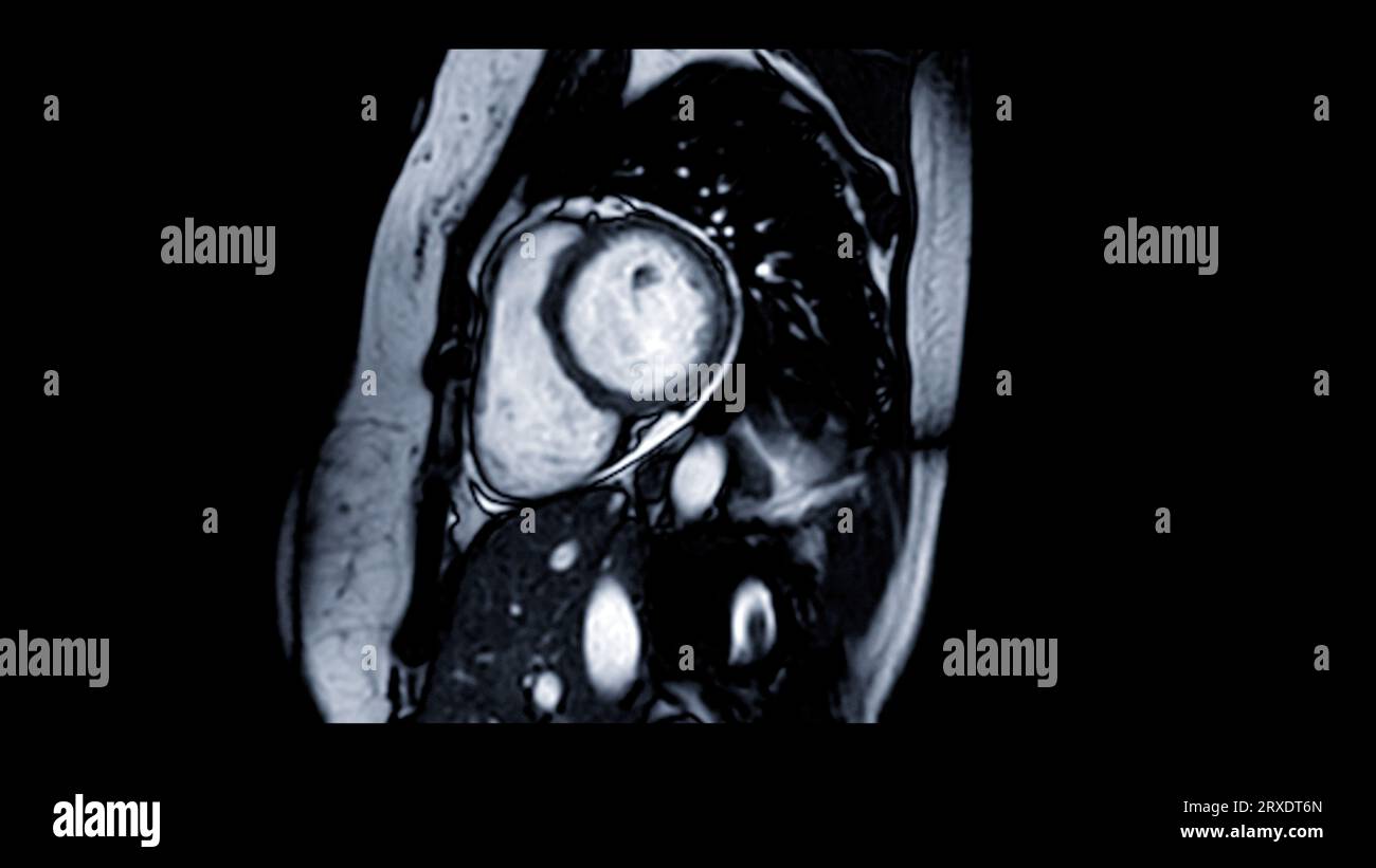MRI heart or Cardiac MRI ( resonance imaging ) of heart in