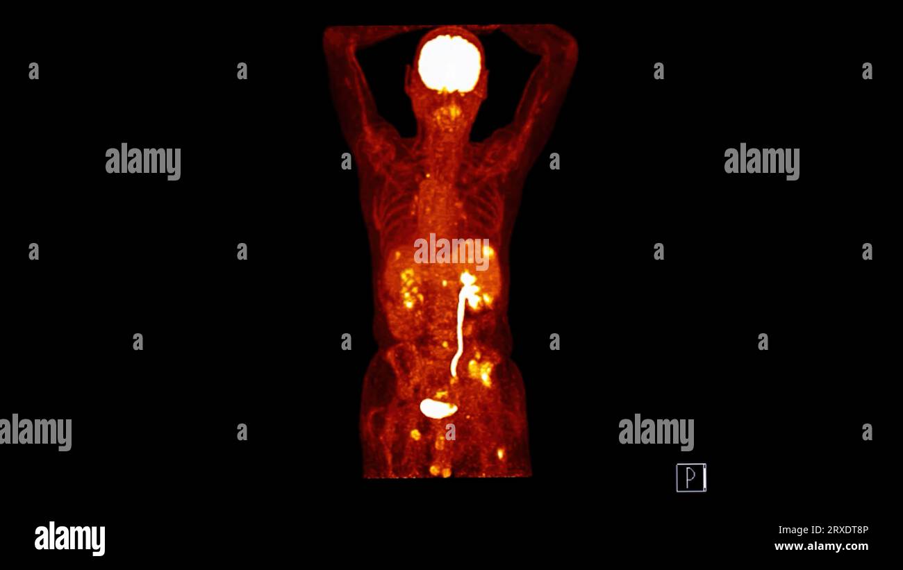 PET CT image of Whole human body  coronal plane. Positron Emission Computed Tomography . Stock Photo