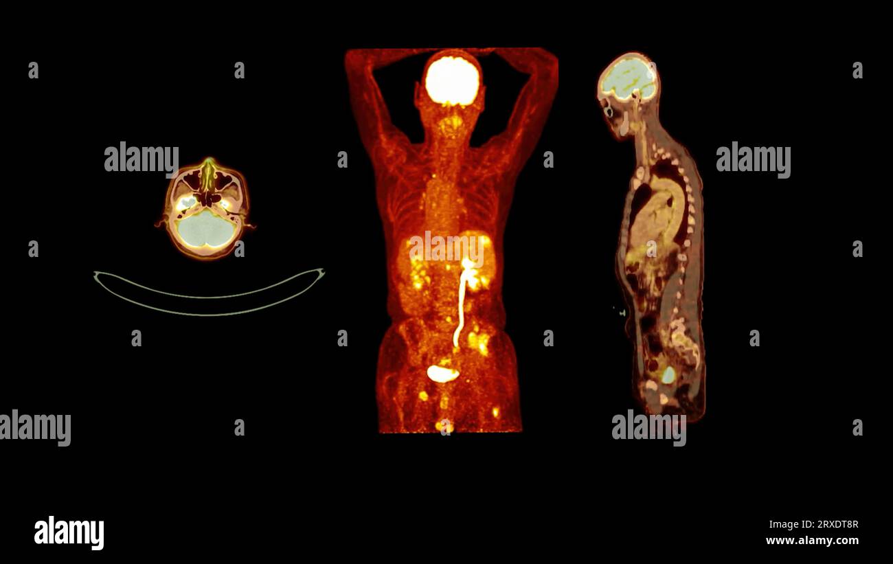 PET CT image of Whole human body Axial ,coronal and sagittal plane