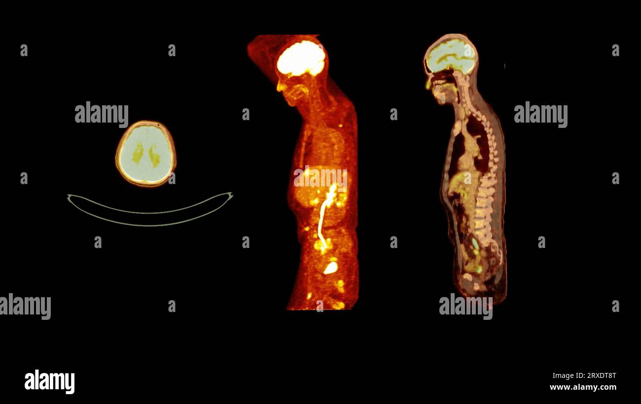 PET CT image of Whole human body Axial ,coronal and sagittal plane ...
