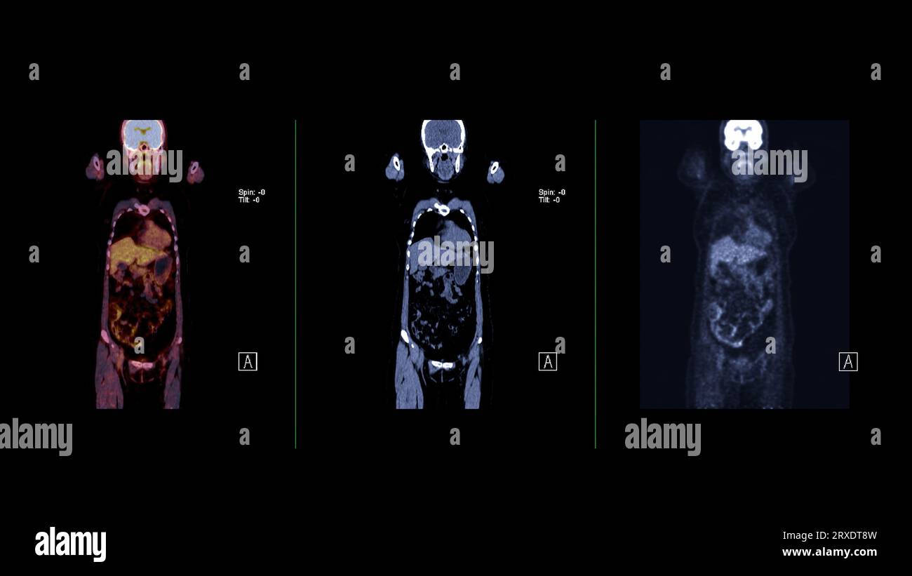 PET CT image of Whole human body Axial ,coronal and sagittal plane ...