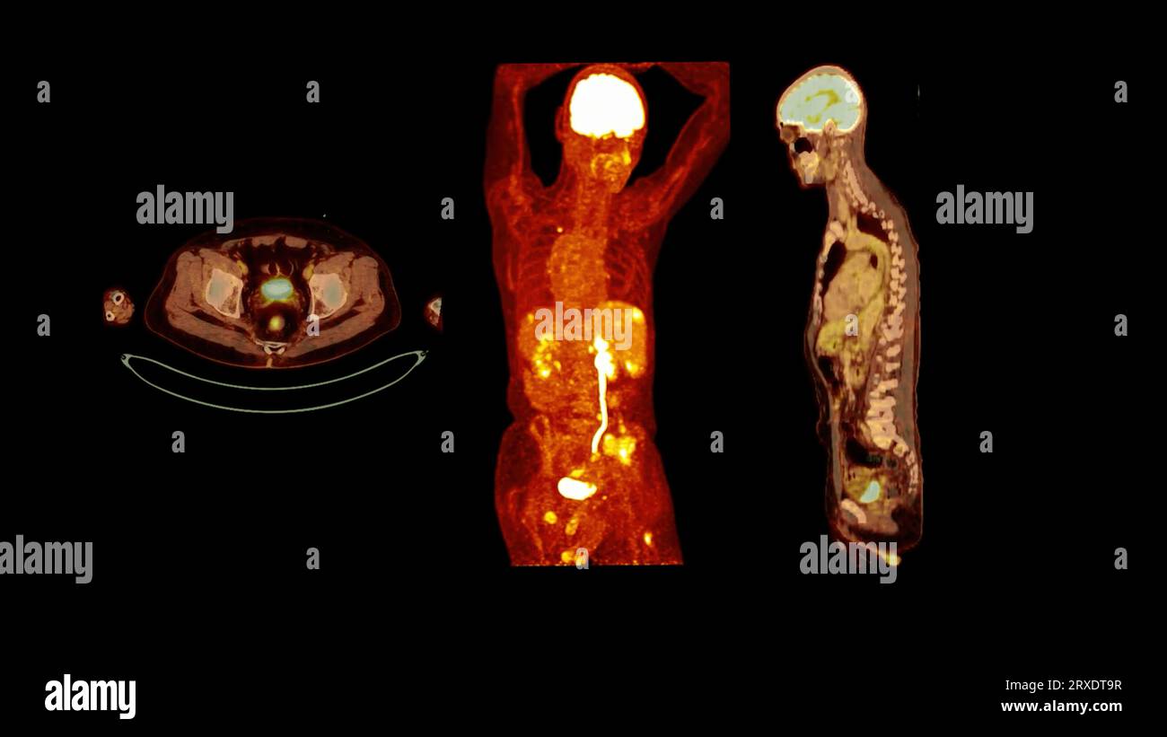 PET CT image of Whole human body Axial ,coronal and sagittal plane ...