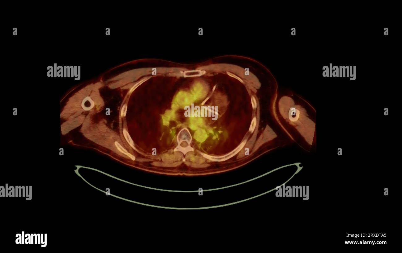 PET CT image of Whole human body Axial plane. Positron Emission