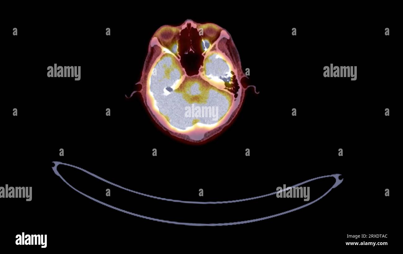 PET CT image of Whole human body Axial plane. Positron Emission ...