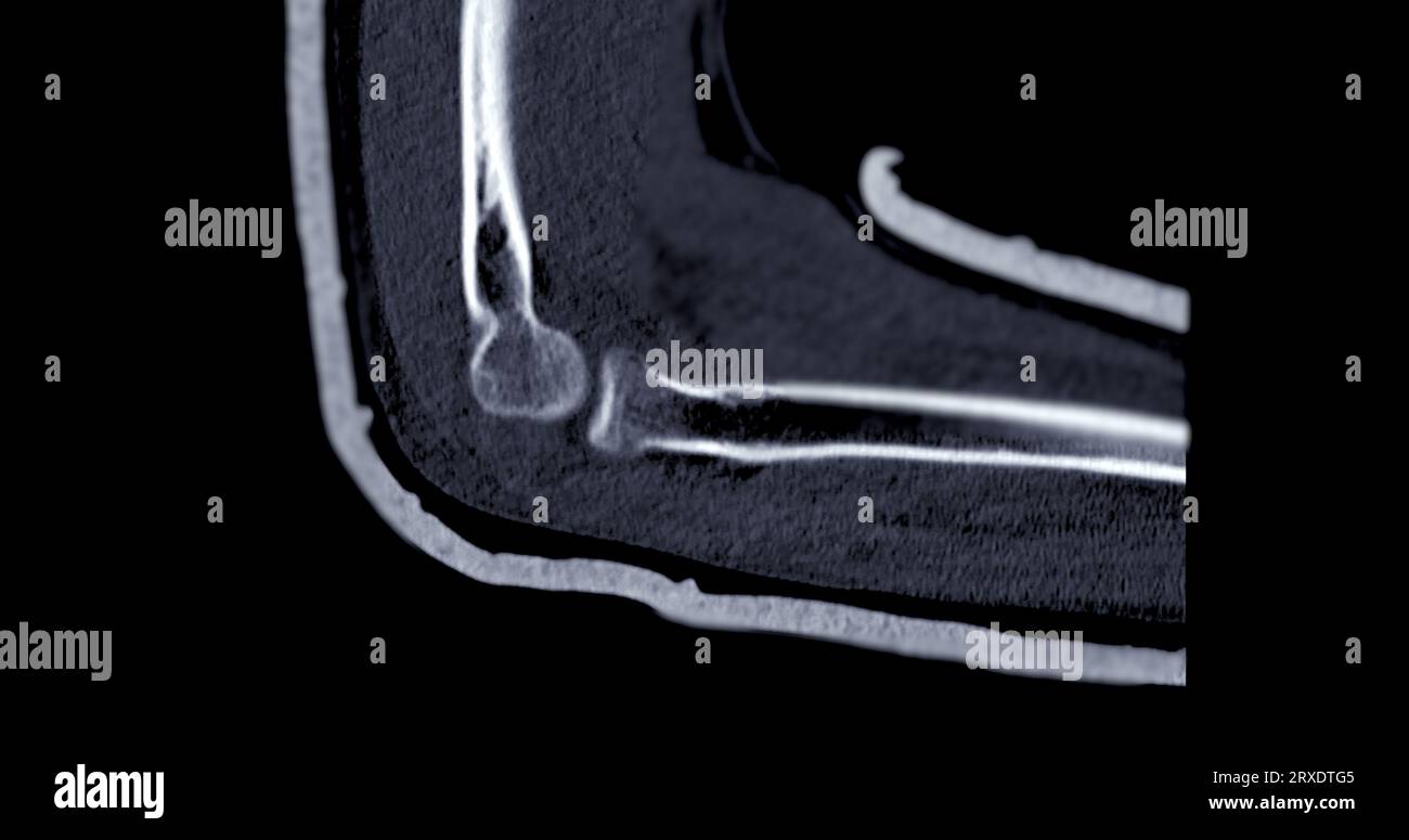 CT scan of elbow joint sagittal view Stock Photo Alamy