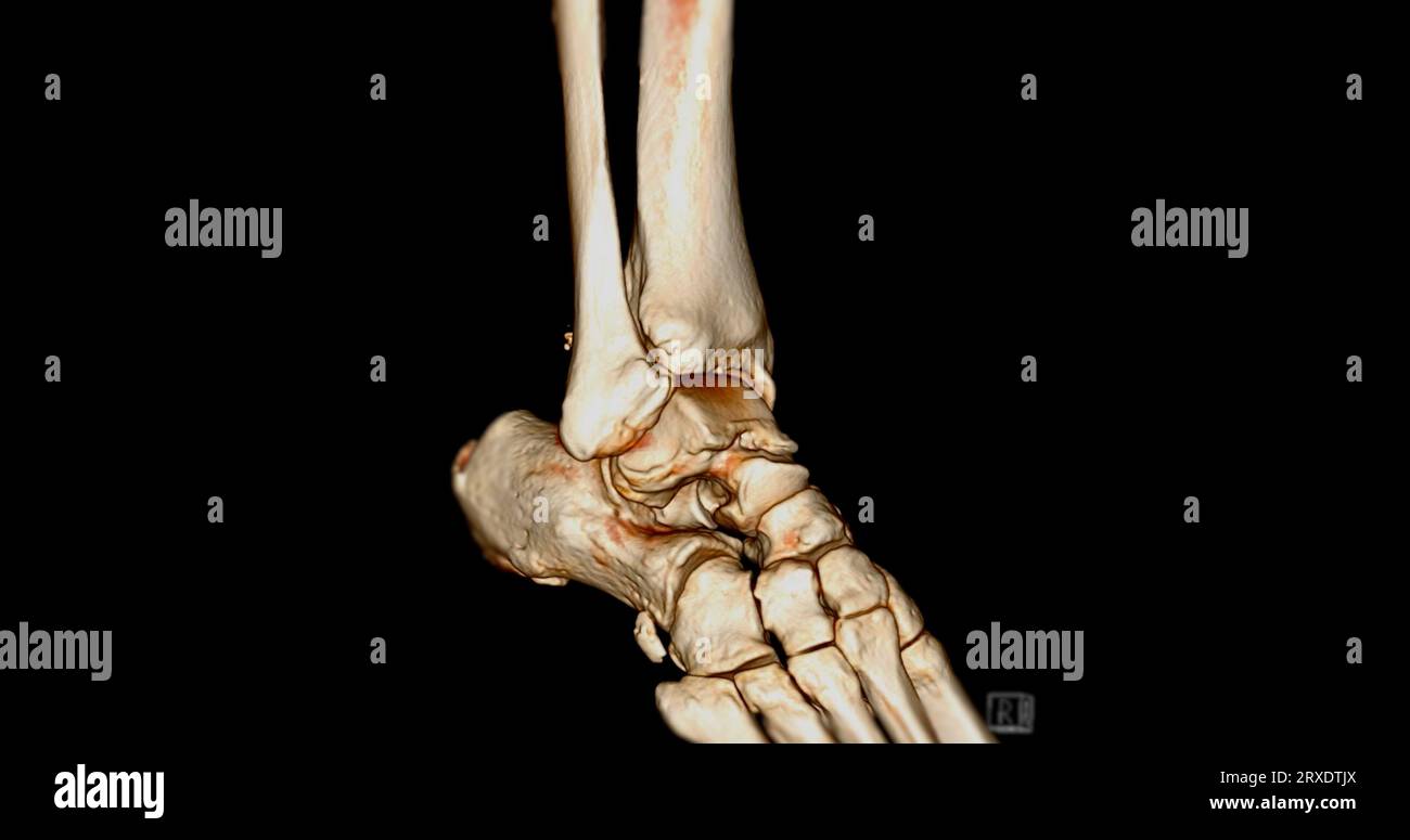 CT Scan ankle joint or Computed Tomography of Ankle joint 3D Rendering