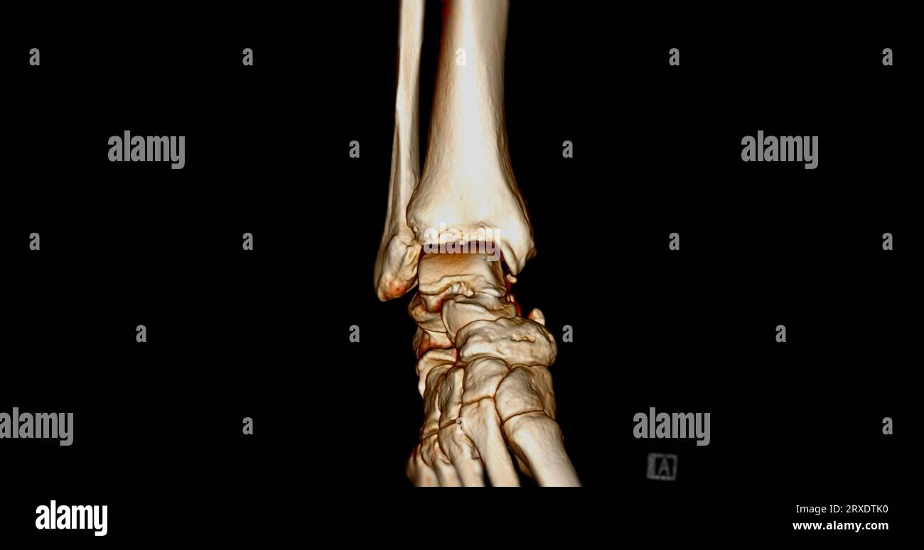 CT Scan ankle joint or Computed Tomography of Ankle joint 3D Rendering