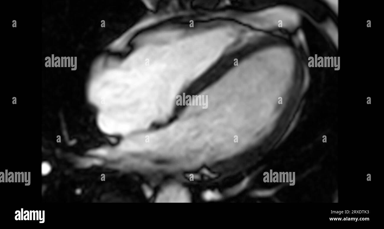 MRI heart or Cardiac MRI ( resonance imaging ) of heart in