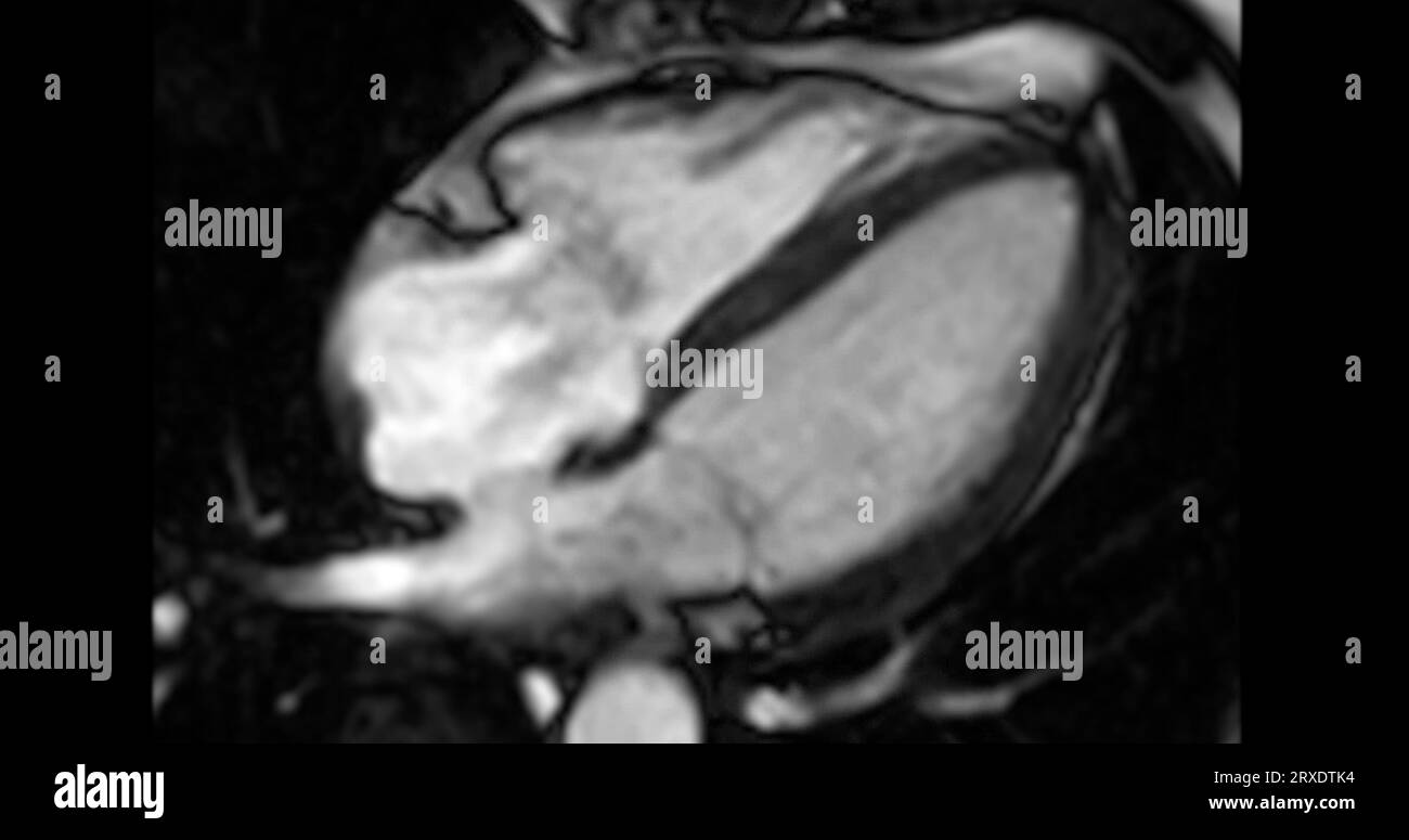 MRI heart or Cardiac MRI ( resonance imaging ) of heart in
