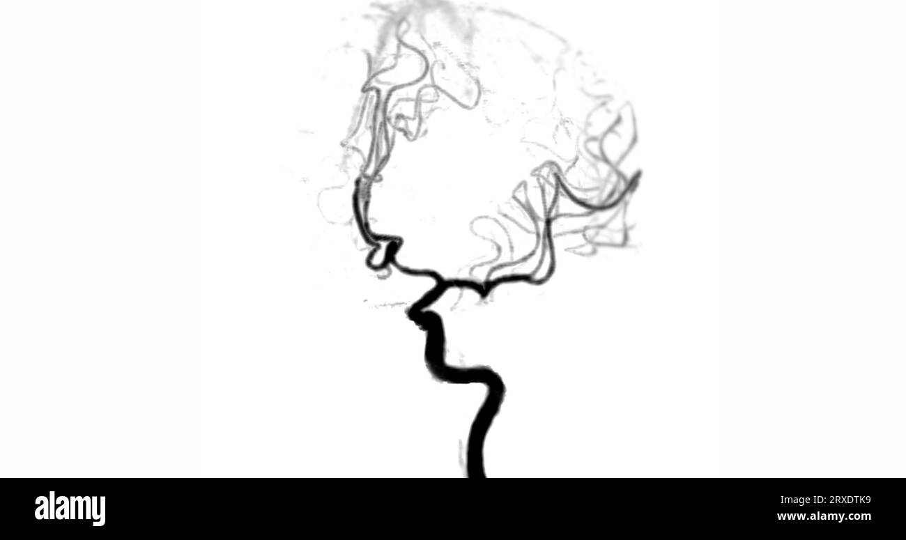CTA BRAIN or CT angiography of the brain angiogram view showing