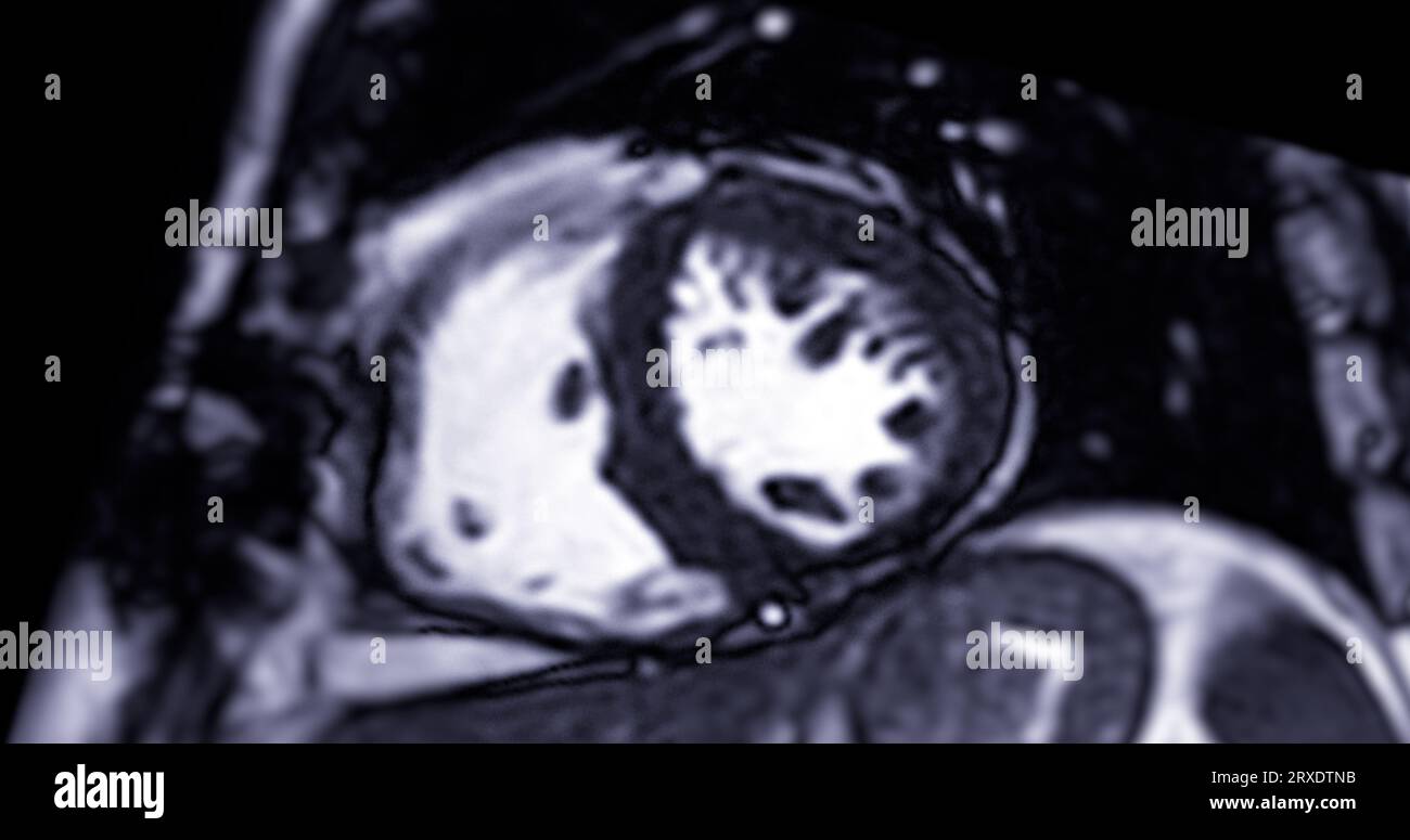 MRI heart or Cardiac MRI ( resonance imaging ) of heart in
