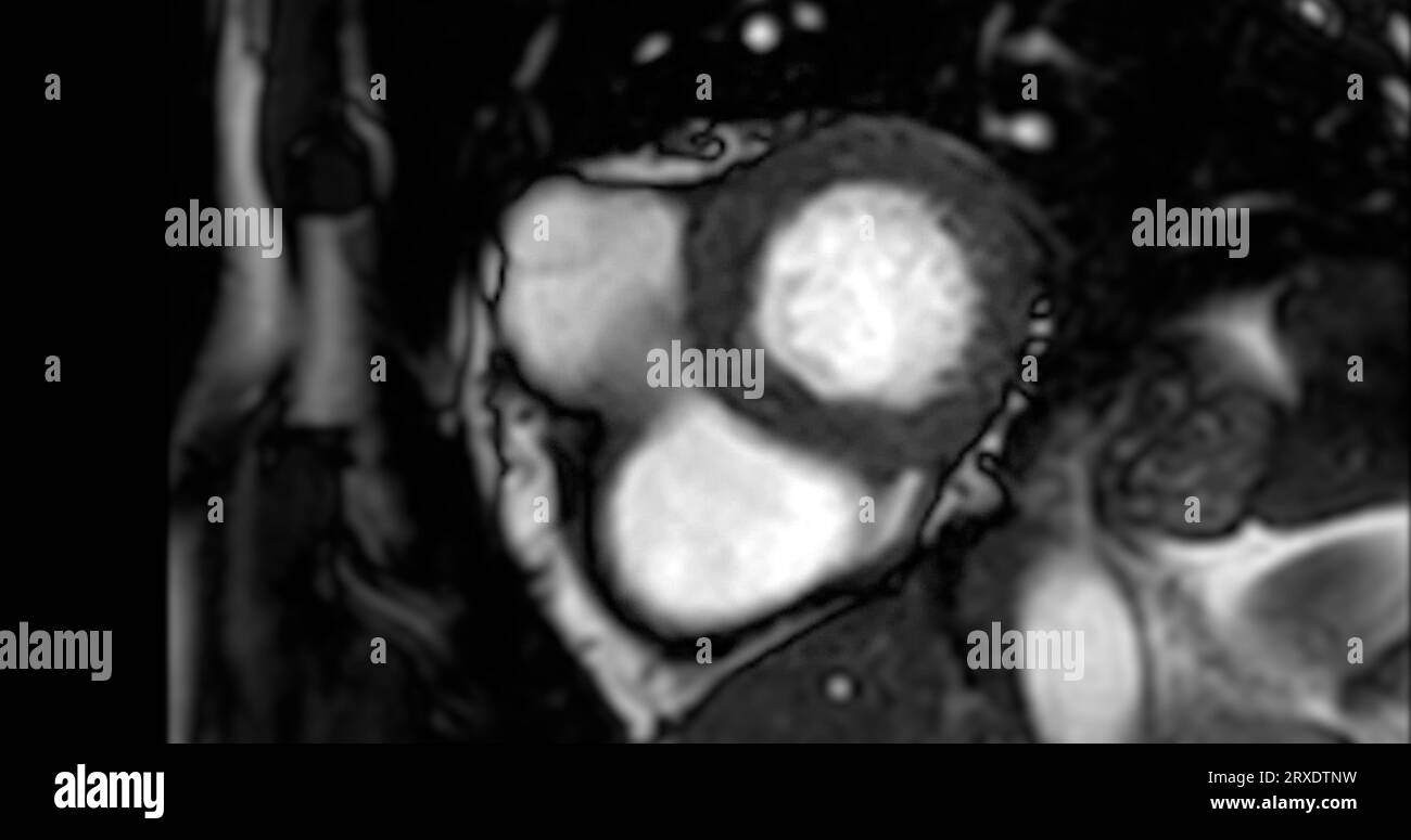 MRI heart or Cardiac MRI ( resonance imaging ) of heart in