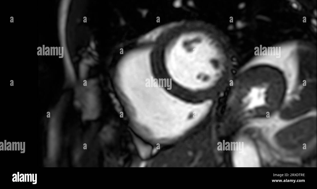 MRI heart or Cardiac MRI ( resonance imaging ) of heart in