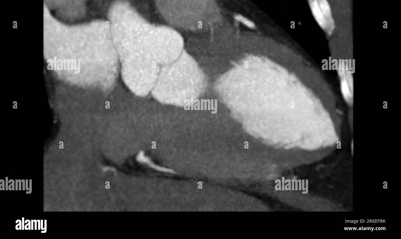 CT Cardiac   or CTA coronary artery vertical long axis view for prevention coronary artery diseases. Stock Photo