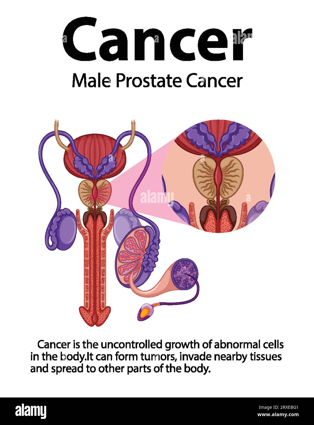 Infographic illustrating the differences between normal and cancerous prostate cells Stock Vector