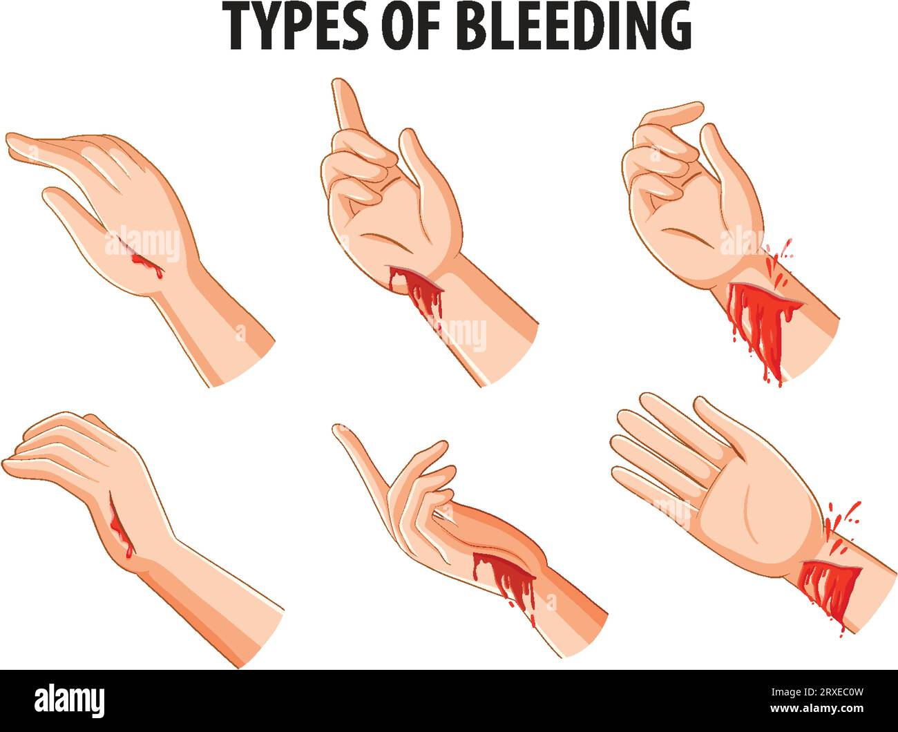 Vector cartoon illustration comparing various types of bleeding on