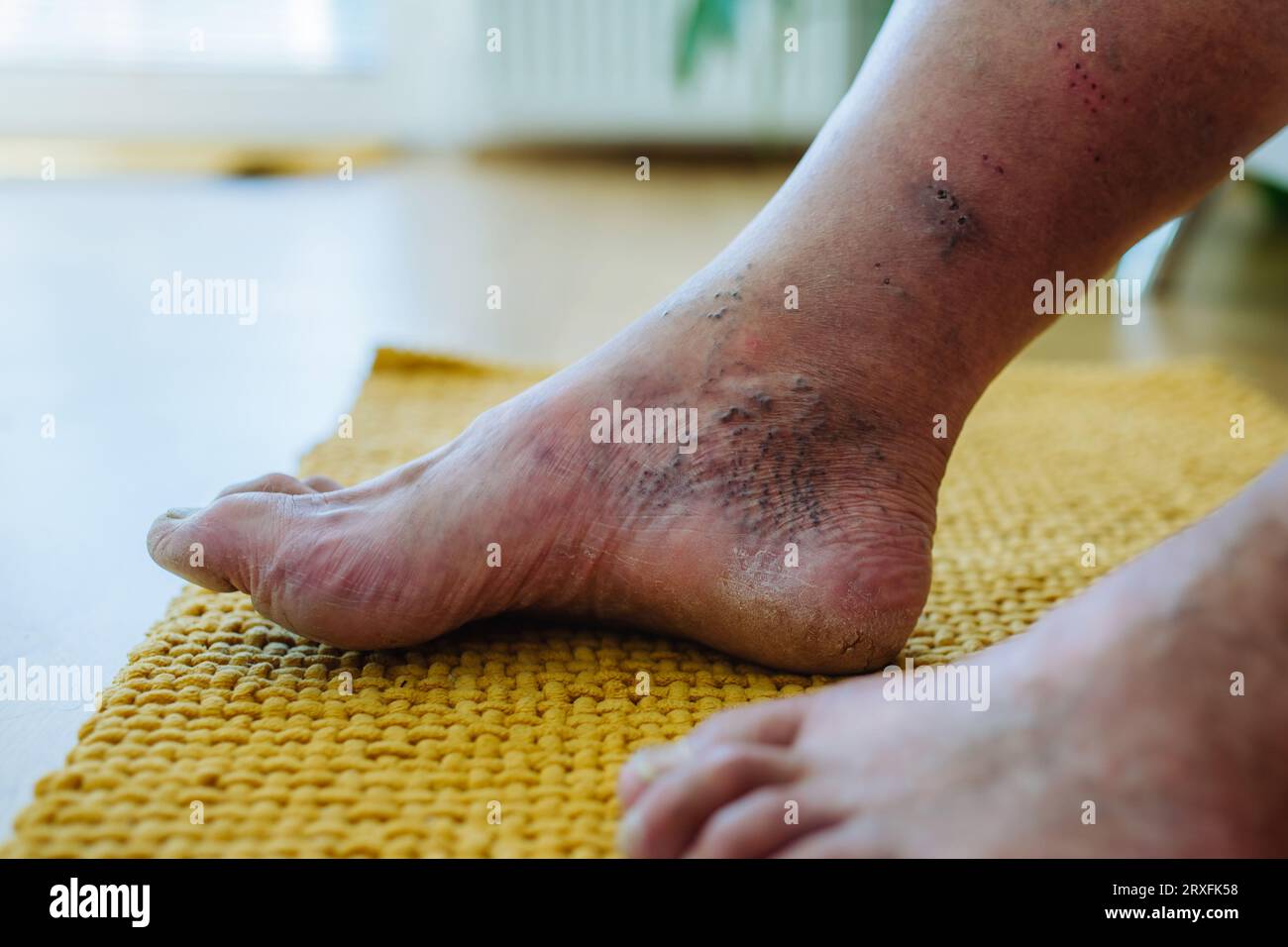 A close-up shot of man's feet with diabetic foot complications. Stock Photo