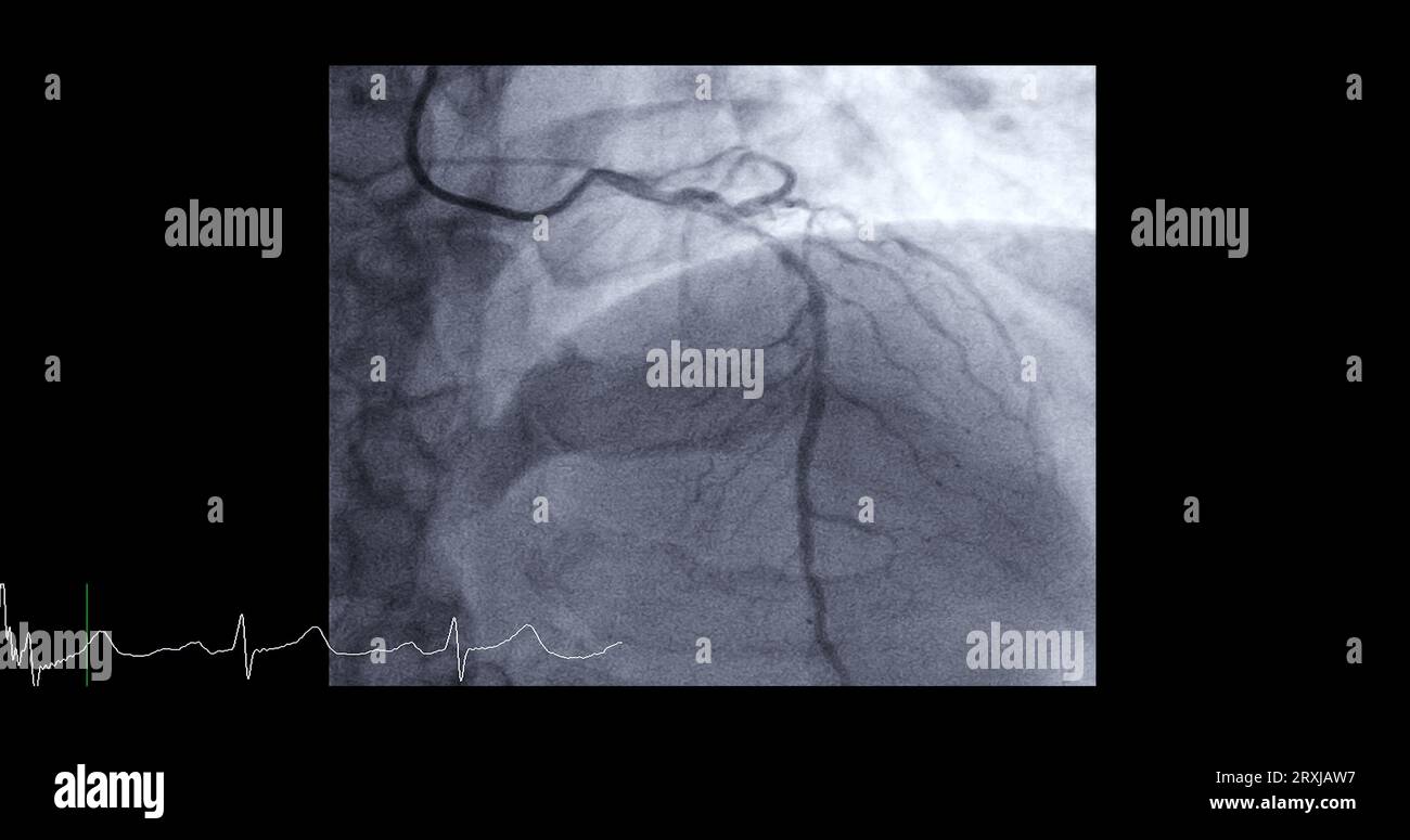 Cardiac catheterization on left anterior descending artery (LAD) can