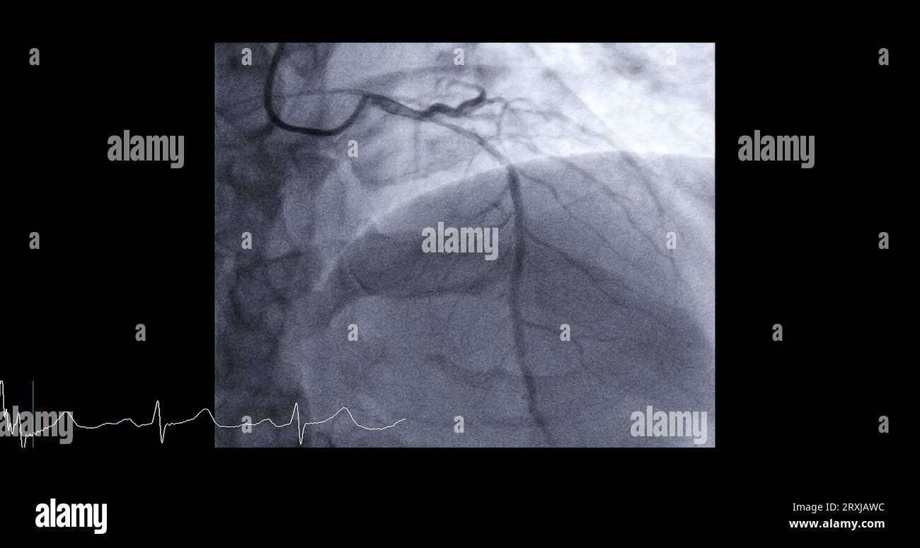 Cardiac catheterization on left anterior descending artery (LAD) can
