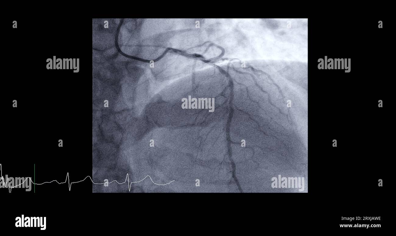 Cardiac catheterization on left anterior descending artery (LAD) can
