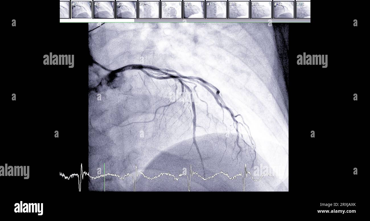 Cardiac catheterization on  left anterior descending artery (LAD) can help doctor diagnose and treat problems in your heart and blood vessels  such as Stock Photo