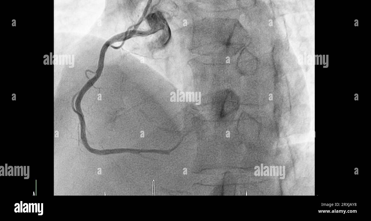 Cardiac catheterization on right coronary artery (RCA) can help doctor diagnose and treat