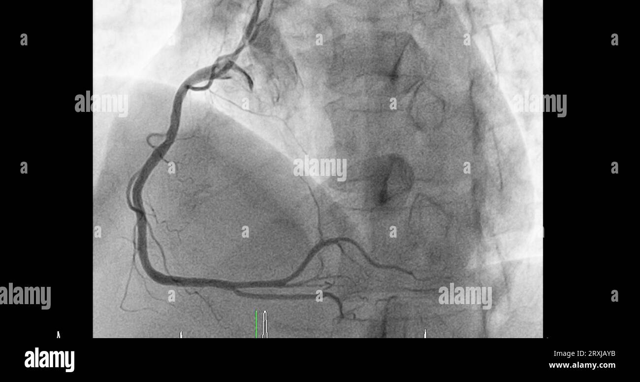 Cardiac catheterization on right coronary artery (RCA) can help doctor diagnose and treat problems in your heart and blood vessels  such as a heart at Stock Photo