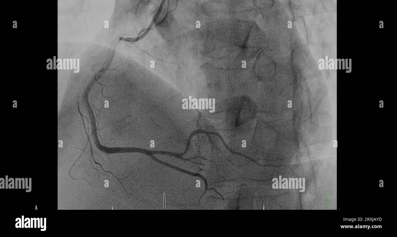 Cardiac catheterization on right coronary artery (RCA) can help doctor diagnose and treat