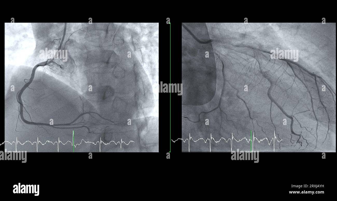 Cardiac catheterization on RCA and LAD can help doctor diagnose and