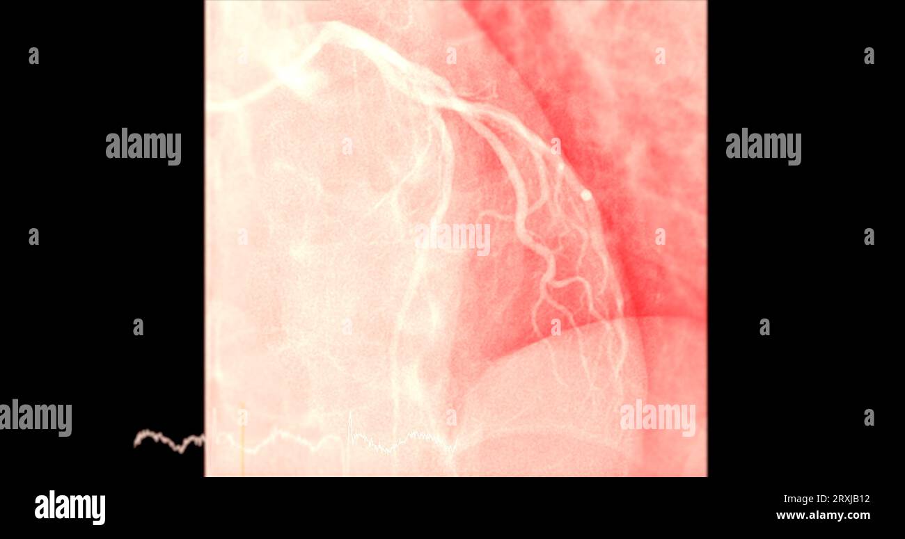 Cardiac catheterization on  left anterior descending artery (LAD) can help doctor diagnose and treat problems in your heart and blood vessels  such as Stock Photo