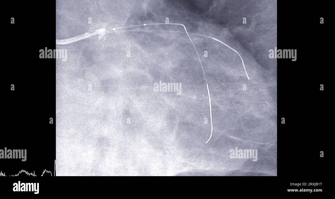 Cardiac catheterization on left anterior descending artery (LAD) can help doctor diagnose and