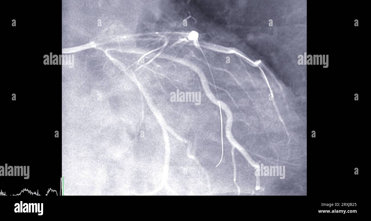 Cardiac catheterization on  left anterior descending artery (LAD) can help doctor diagnose and treat problems in your heart and blood vessels  such as Stock Photo