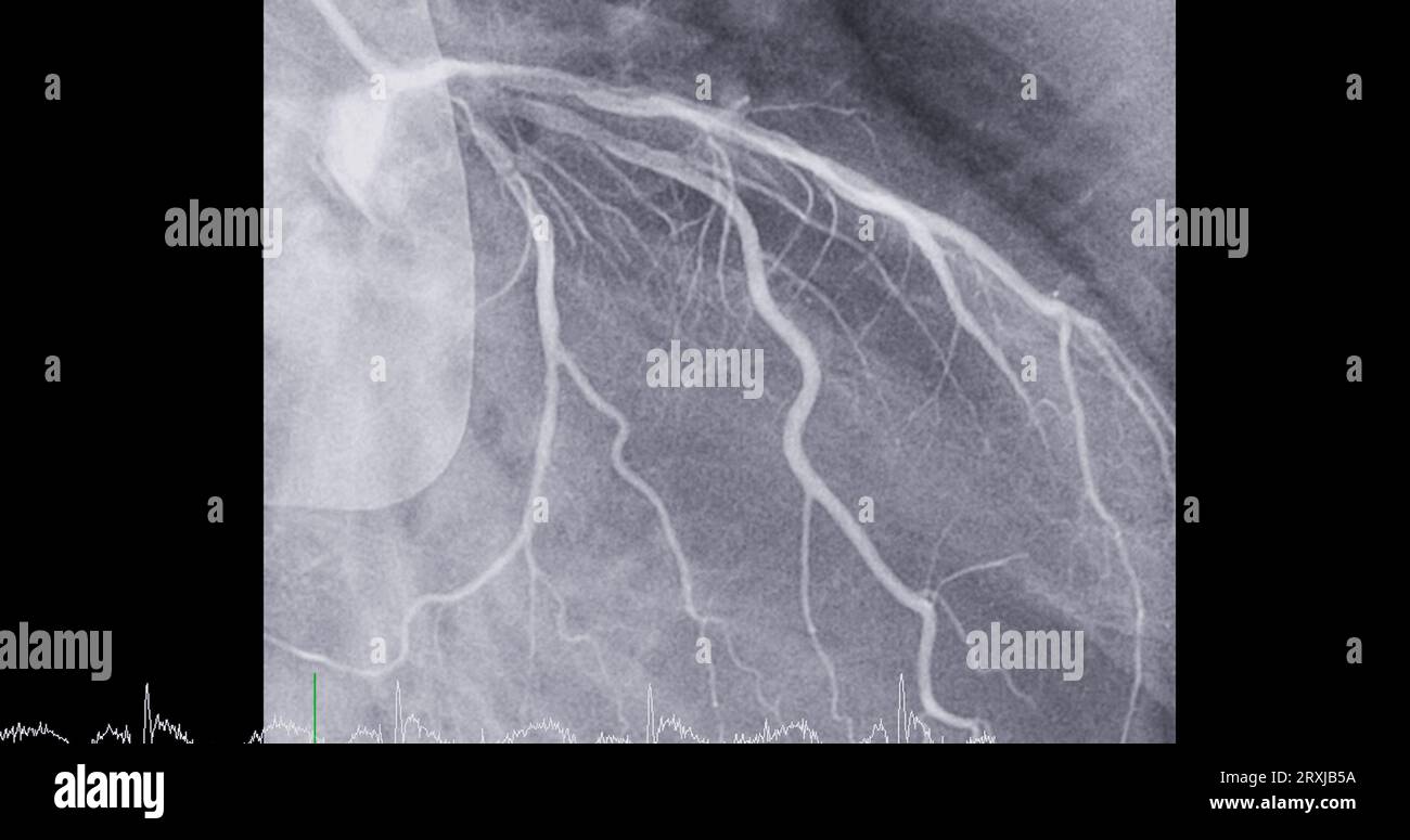 Cardiac catheterization on left anterior descending artery (LAD) can