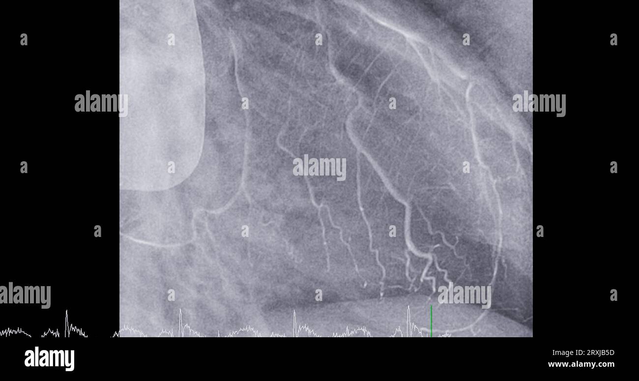 Cardiac catheterization on left anterior descending artery (LAD) can help doctor diagnose and