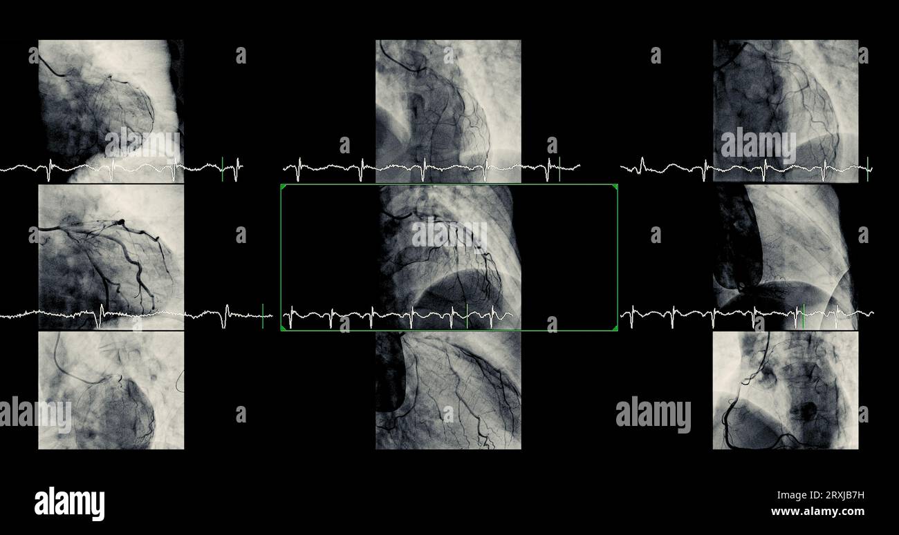 Cardiac catheterization can help doctor diagnose and treat problems in ...