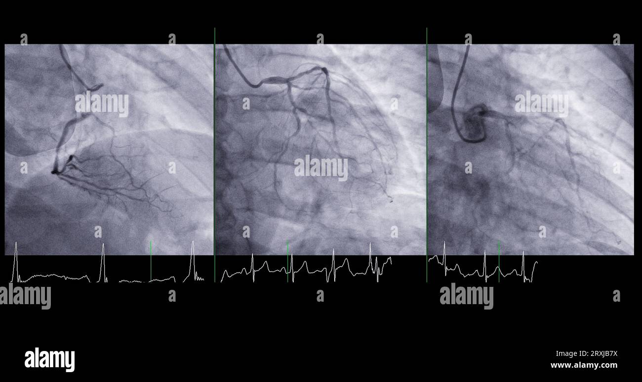Cardiac catheterization can help doctor diagnose and treat problems in your heart and blood