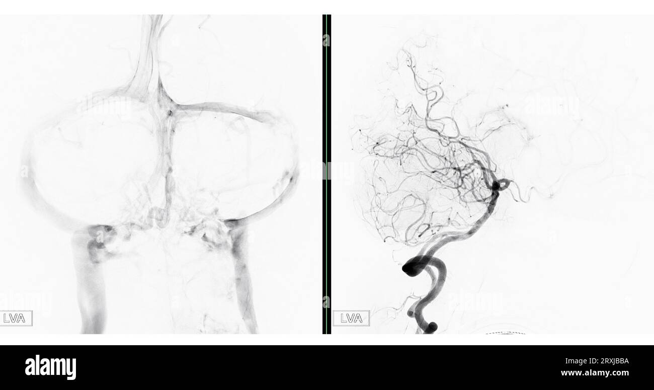 Cerebral angiography image from Fluoroscopy in intervention radiology