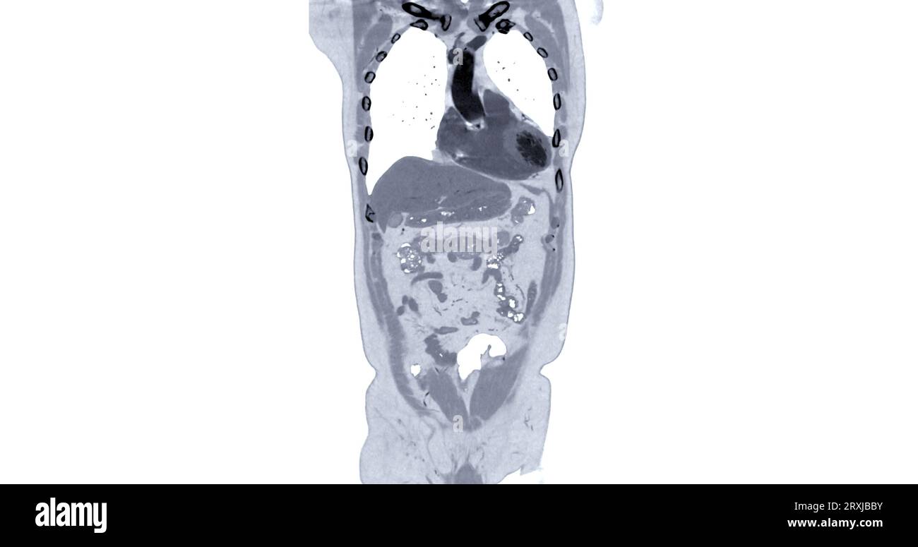 CT Chest and Abdomen with injection contrast media coronal view for diagnosis chest and