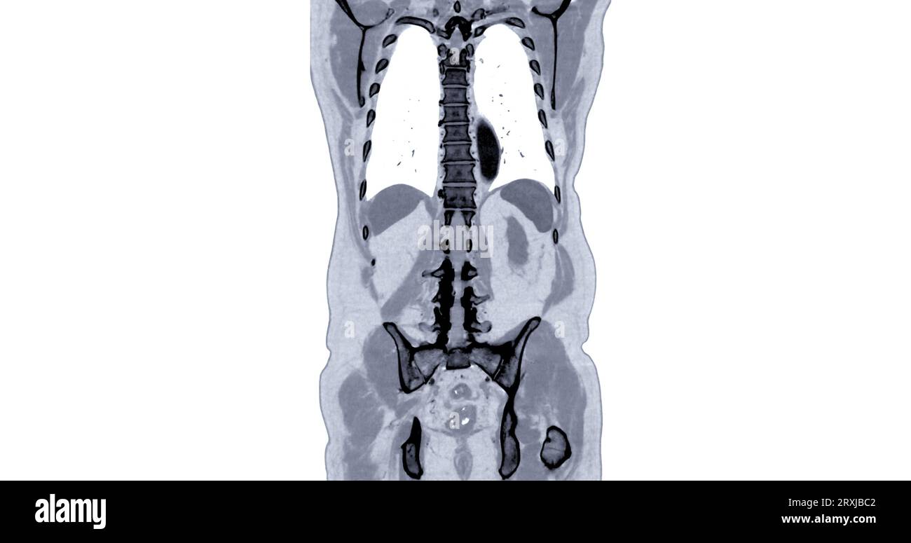 CT Chest and Abdomen with injection contrast media coronal view for diagnosis chest and