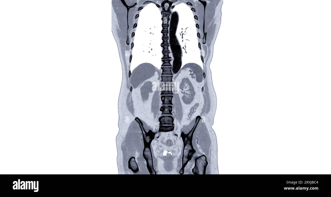 CT Chest and Abdomen with injection contrast media coronal view for diagnosis chest and