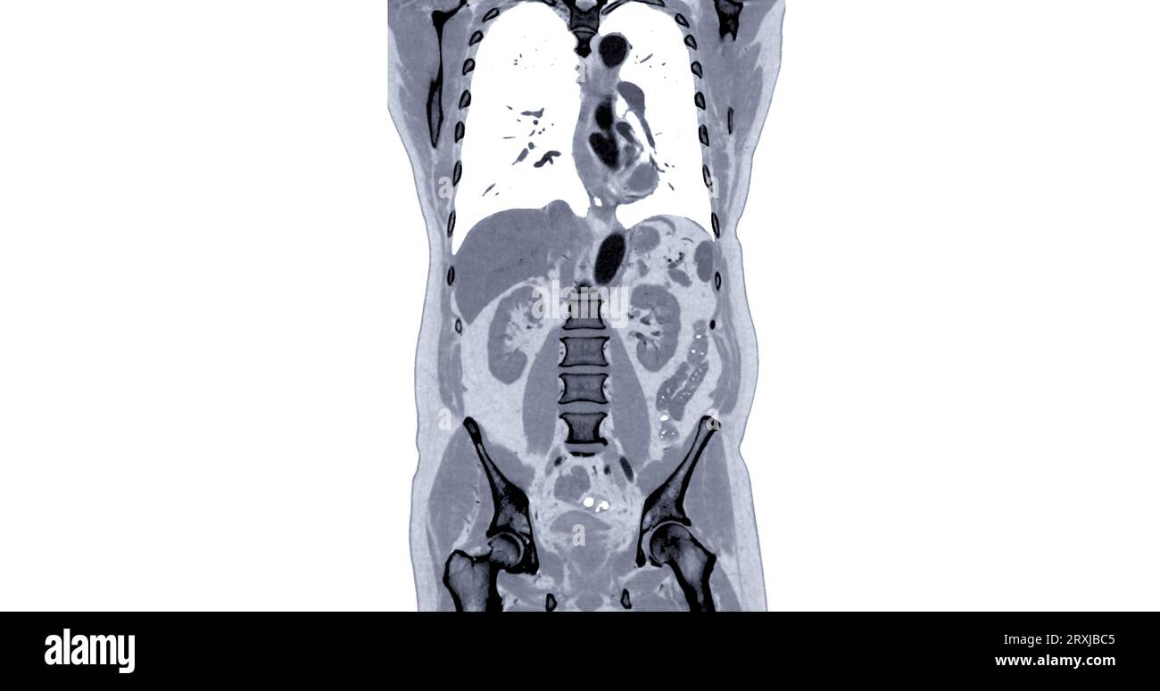 CT Chest and Abdomen with injection contrast media coronal view for diagnosis chest and